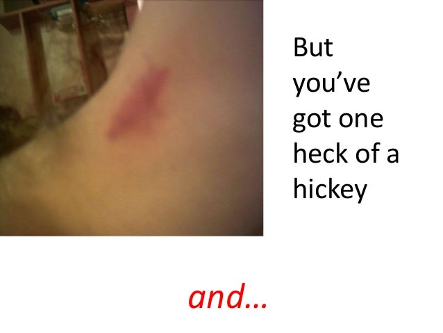 Getting rid of a hickey fast